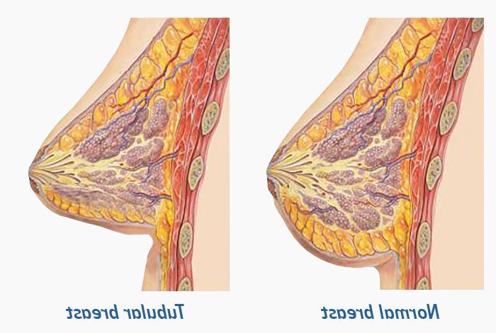 Tubular Breast Correction